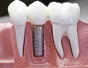 Несколько причин, согласно которых нужно прибегнуть к имплантации зубов