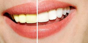 Отбеливание зубов дома или у стоматолога?