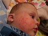 Аллергический дерматит у детей: принимаем меры к устранению