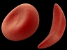 Теперь есть лекарство от серповидноклеточной анемии?