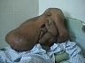 Мексиканские хирурги  удалили у двухлетнего мальчика опухоль, весом в пятнадцать килограммов