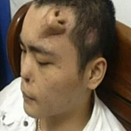 Китай: нос для трансплантации выращен на лбу пациента