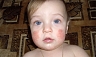 Атопический (аллергический) дерматит у детей: расставляем точки над «і»
