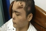 Китай: нос для трансплантации выращен на лбу пациента